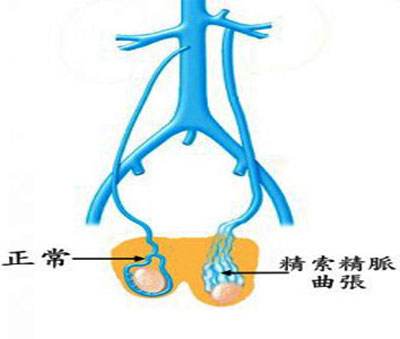 精索靜脈曲張微創(chuàng)手術(shù)費用多少